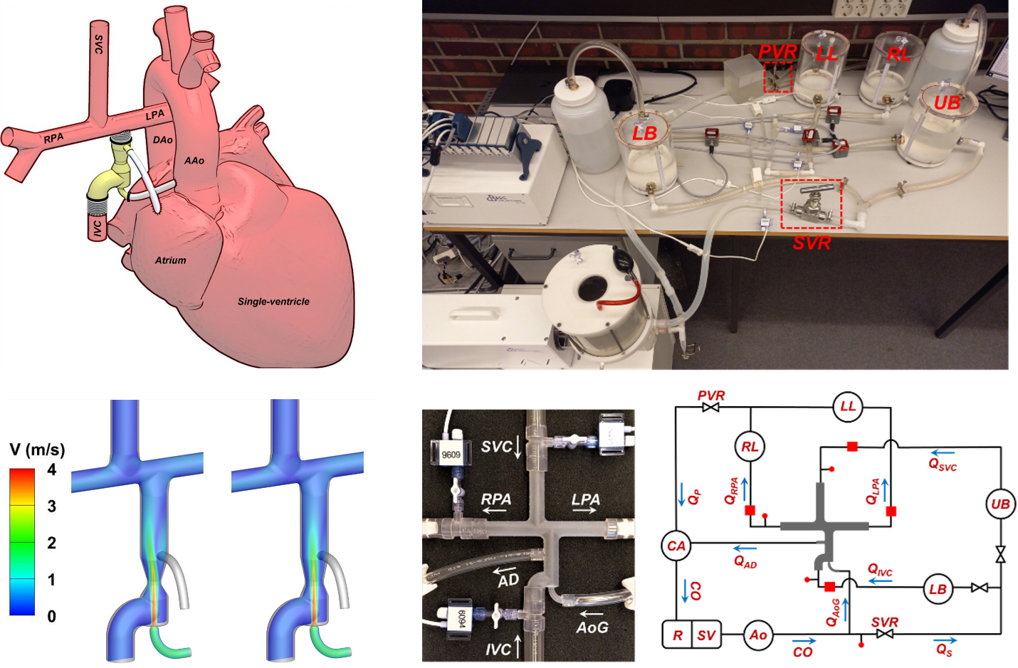 Palliative strategies for single-ventricle heart disease management